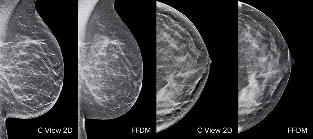 Immagini di mammografie
