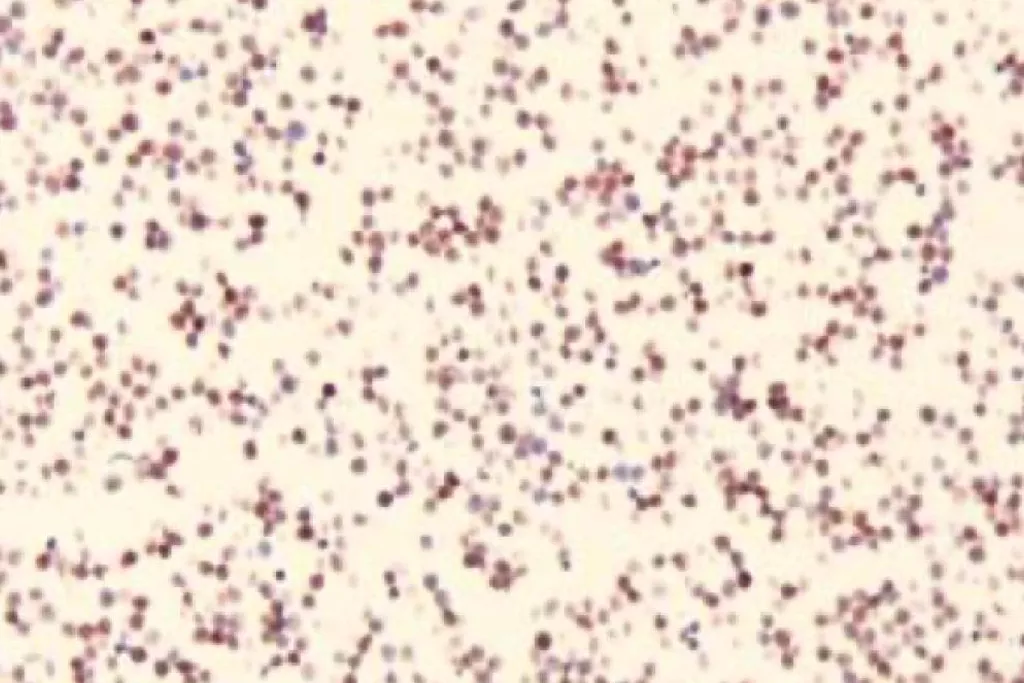 Citoincluso con colorazione delle cellule positive per il linfoma a cellule T