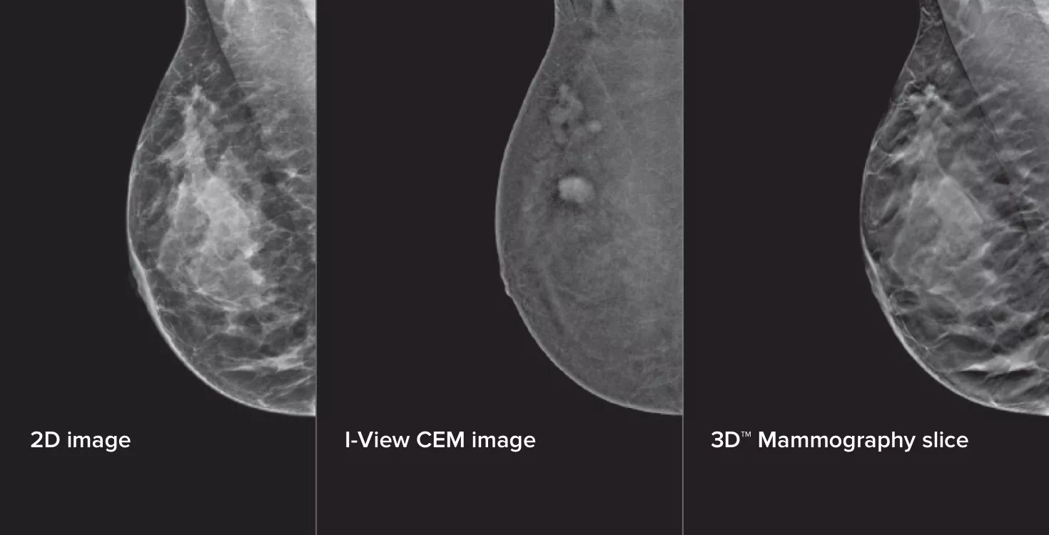 Mammografie