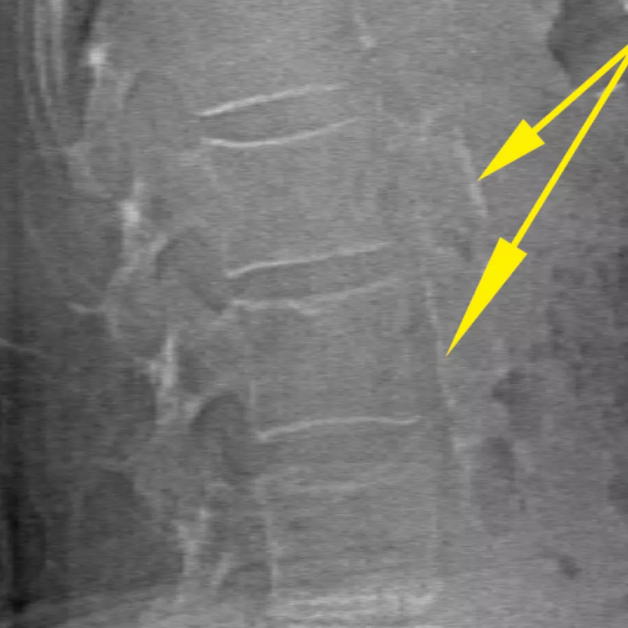 BMD e imaging delle ossa per l'osteoporosi e le patologie ossee