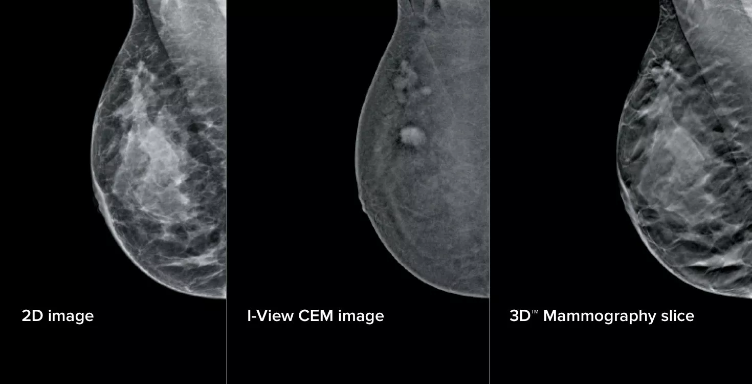 Mammografie