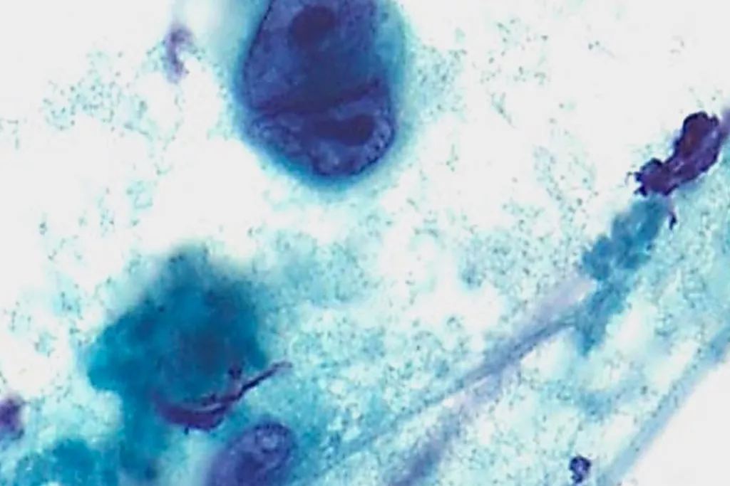 Linfoma di Hodgkin, FNA del collo, colorazione di Papanicolaou