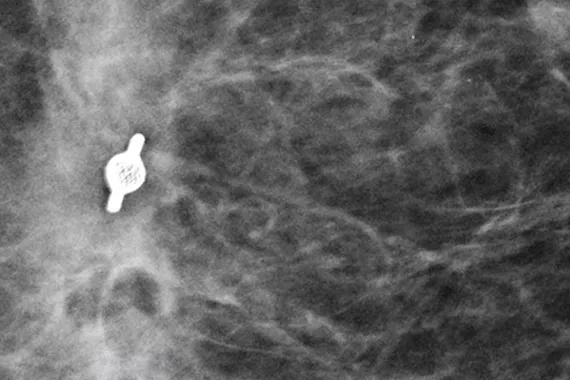 Immagine del marcatore del sito bioptico in mammografia