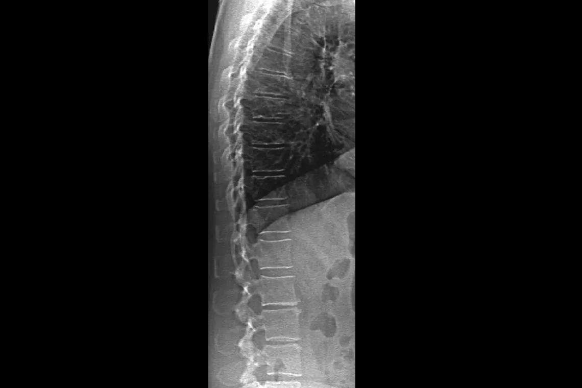 radiografia della colonna vertebrale