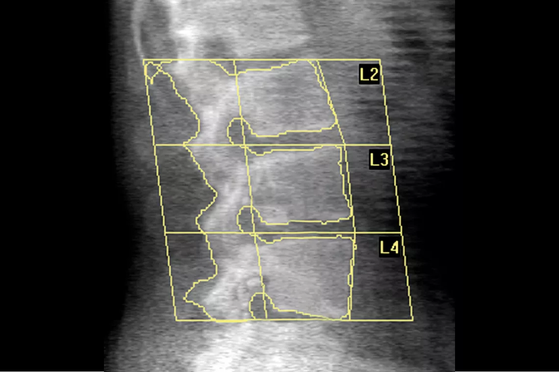 radiografia della colonna vertebrale