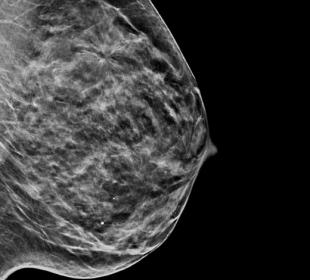 Immagini Sintetiche C-View™ Hologic su sfondo bianco