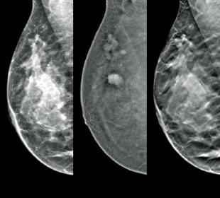 Imaging con Contrasto I-View™ di Hologic