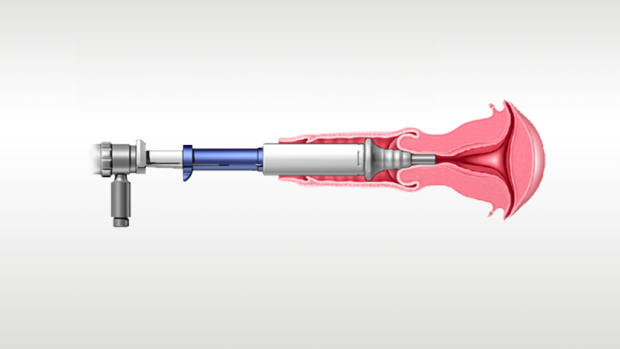 Illustrazione di un dispositivo medico in uso.