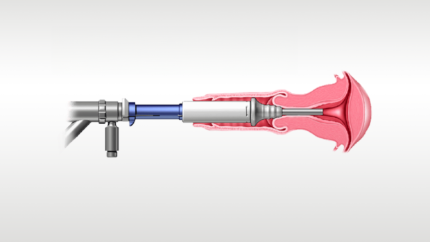 Illustrazione di un dispositivo medico in uso.